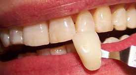 Patient's teeth after Teeth Whitening | Advanced Dental Technology of Ithaca II PLLC