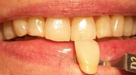 Patient's teeth before Teeth Whitening | Advanced Dental Technology of Ithaca II PLLC