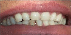Patient's mouth before porcelain veneers by Dr. Zax
