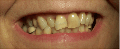 Patient's teeth before dental bonding