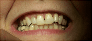 Patient's teeth after dental bonding | Advanced Dental Technology of Ithaca II, PLLC