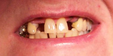 Patient's mouth before dental implants