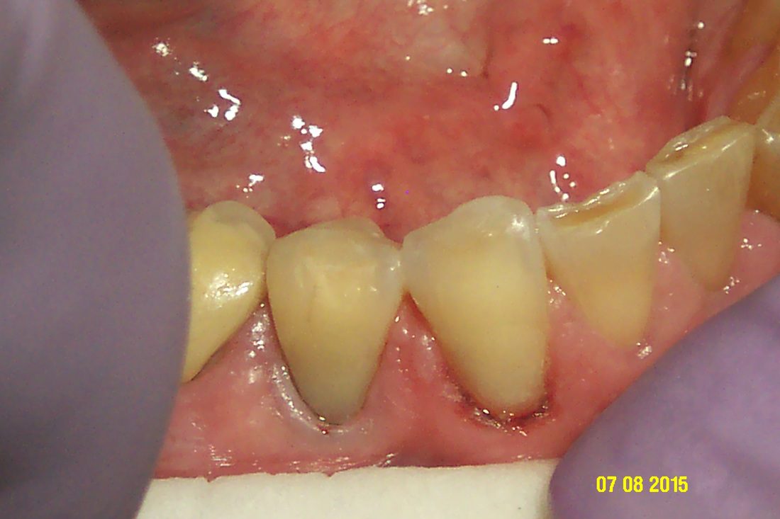 Tooth abfraction restoration
