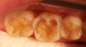 Tooth erosion before restoration