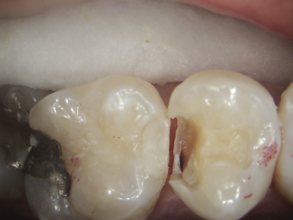 Tooth erosion before restoration