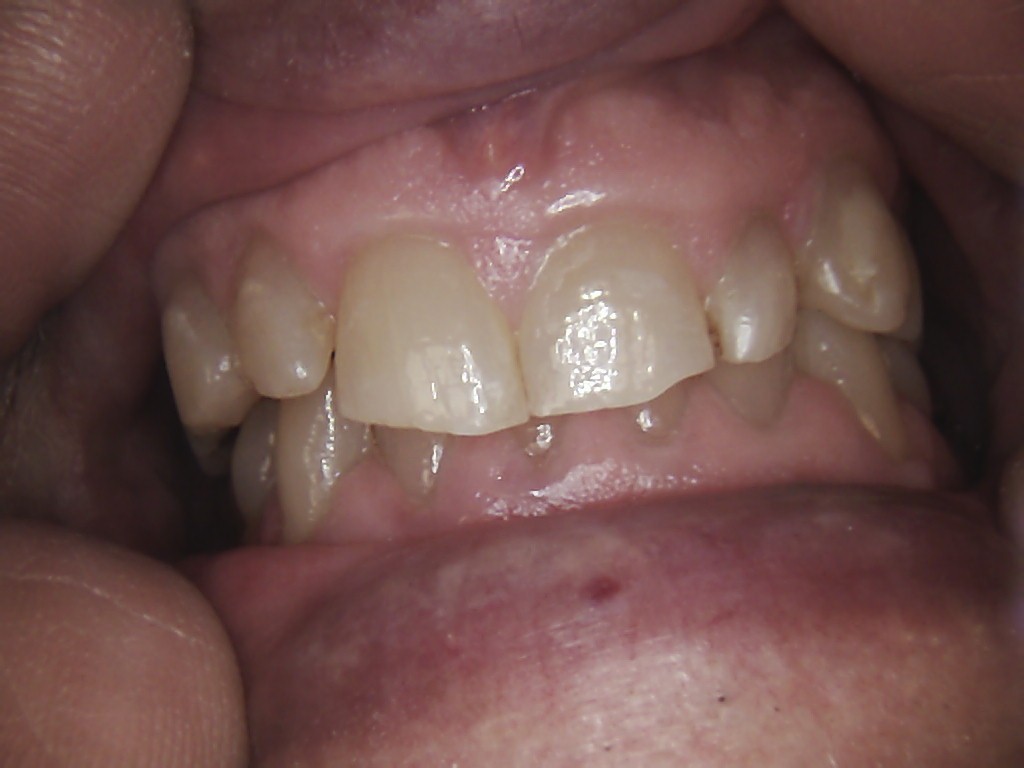 Tooth abfractions
