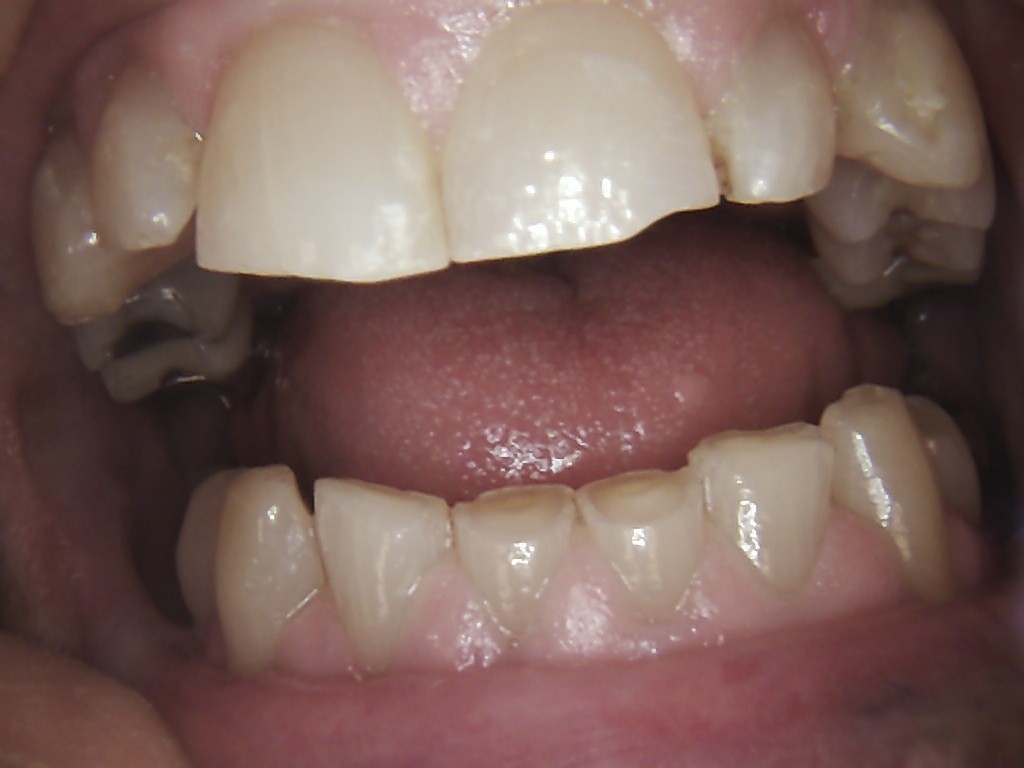 Tooth abfractions