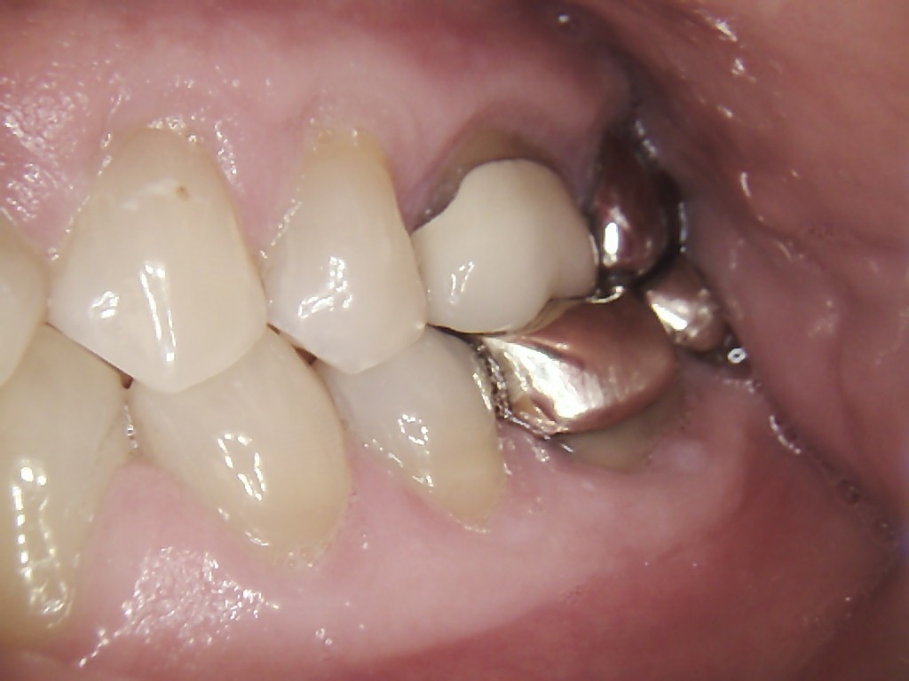 Tooth abfractions